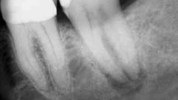 Un suivi de huit ans d’une réimplantation intentionnelle parfaitement réussie