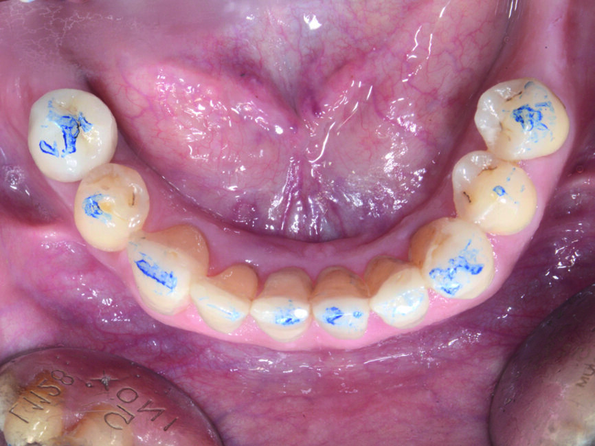 Fig. 23 : Vérification fonctionnelle de l’occlusion au niveau de l’arcade mandibulaire.
