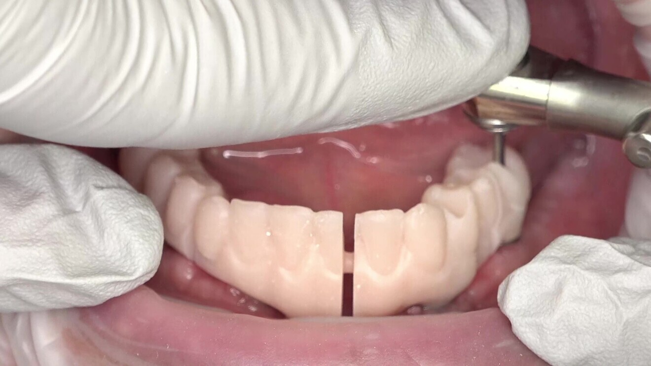 Fig. 10: Adjusted validator try-in without fractures in the lower jaw.