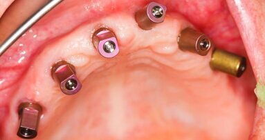 Nova nanotecnologia poderá melhorar a restauração óssea dos pacientes na Odontologia