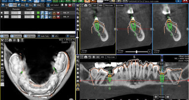 Ugradnja implantata upotrebom hirurškog stenta