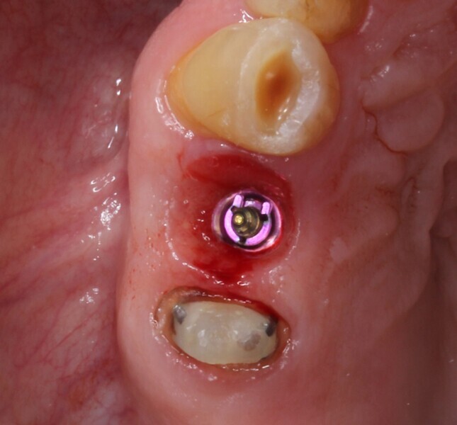 Fig. 21: Situation after removal of the provisional restoration.