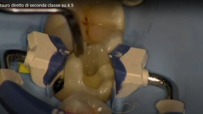 Restauro diretto di seconda classe su 4.5