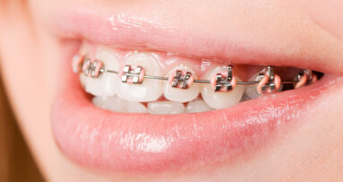 VÖK rät zu KFO-Behandlungsstart zu Beginn der Pubertät