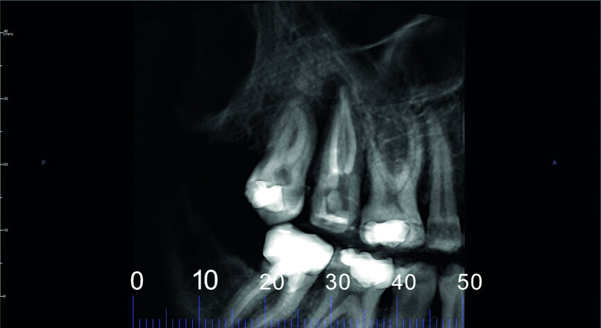 Fig. 4: Pre-op CBCT scan, pseudo-panoramic view.