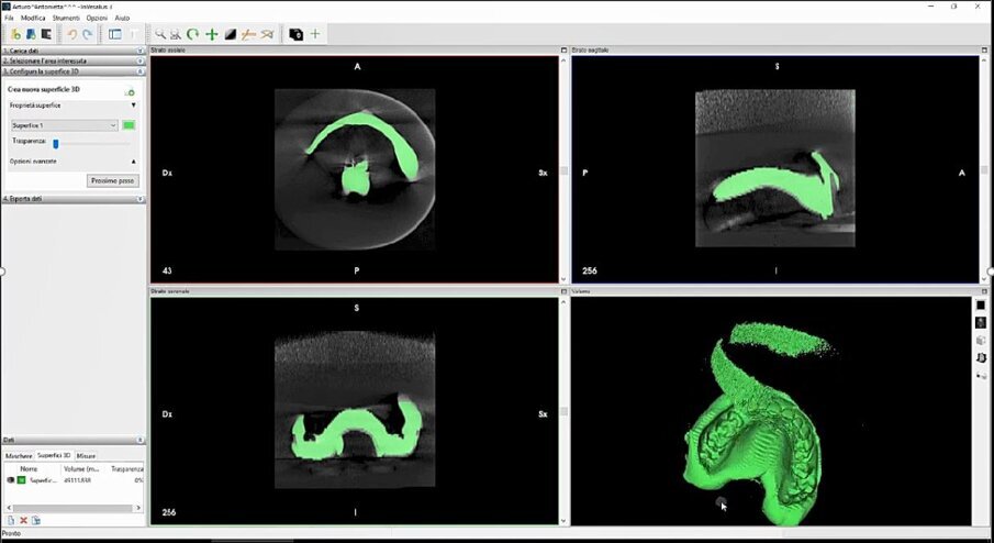 Fig. 7_Segmentazione e conversione dei files DICOM in STL mediante software free Invesalius.
