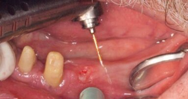 Innowacyjne sposoby usuwania tkanek przy użyciu lasera Er:YAG