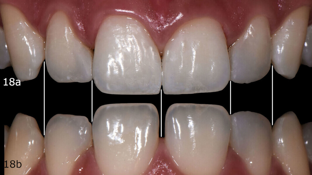 Figs. 18a & b: Space closure comparative check on the digital smile design before (a) and after (b).