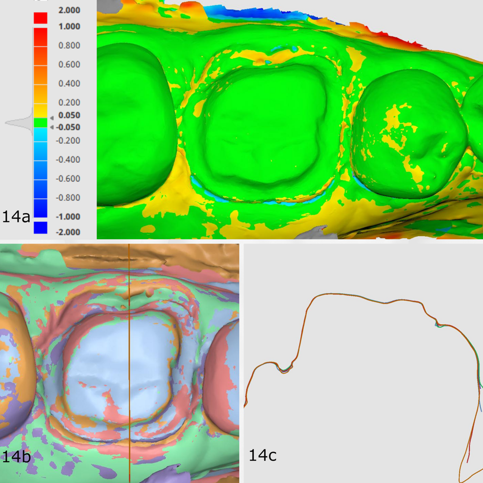 Figs. 14a–c: Deviation map of the scans compared with CEREC Primescan’s scan (a; scale of 50 μm) and sectional view (b & c). Very little deviation around the preparation area.