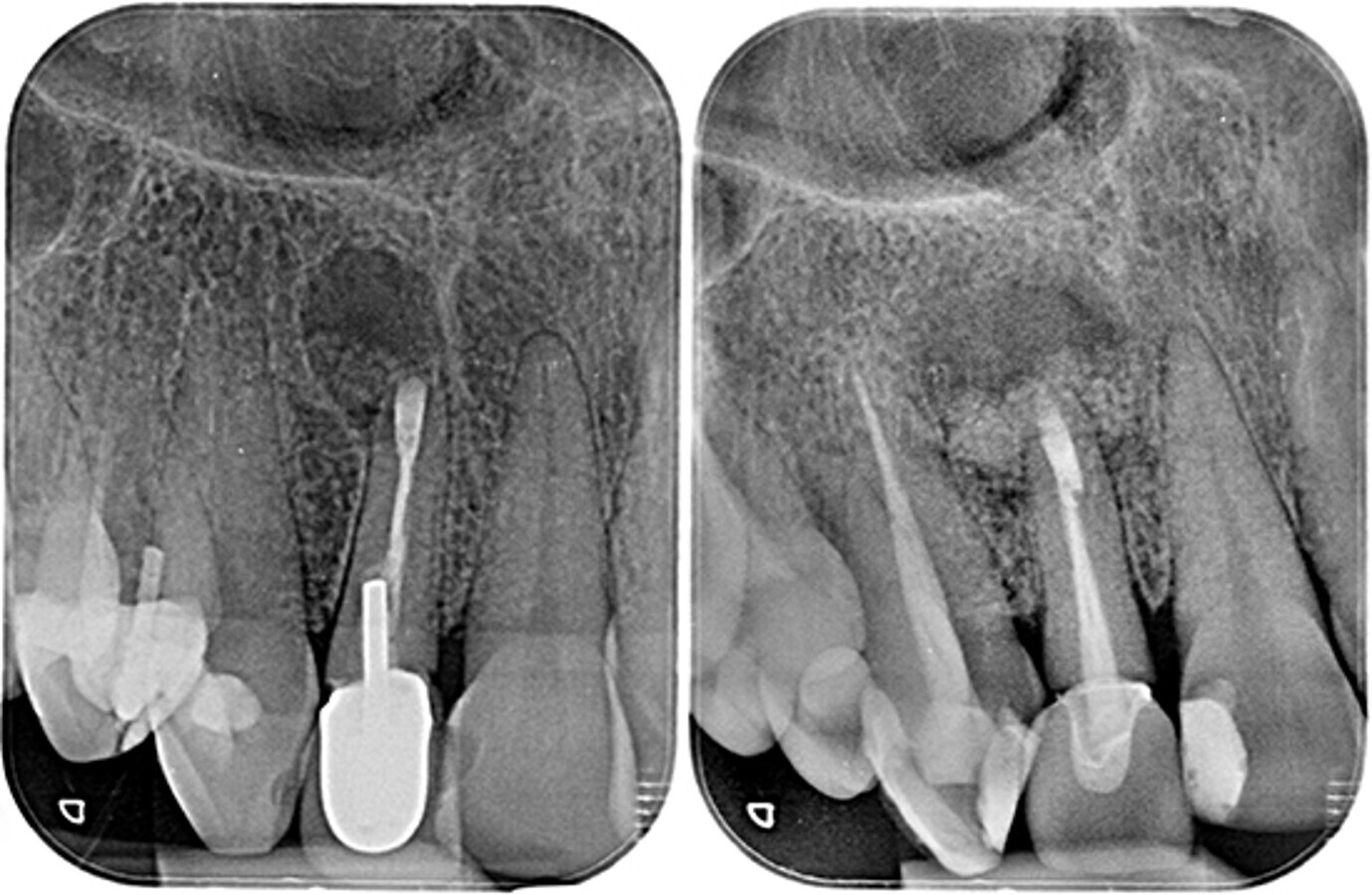 Figura 10 y 11. RadiografÃ­as intraorales postoperatorias 