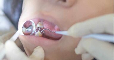 Für den Erhalt von Amalgam – Stellungnahme von BZÄK und KZBV