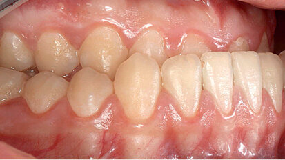 Komplexní ortodonticko-chirurgické ošetření funkčně estetické vady