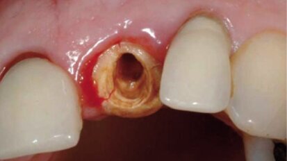Czy recesja tkanki miękkiej wokół implantów wciąż jest nieunikniona?