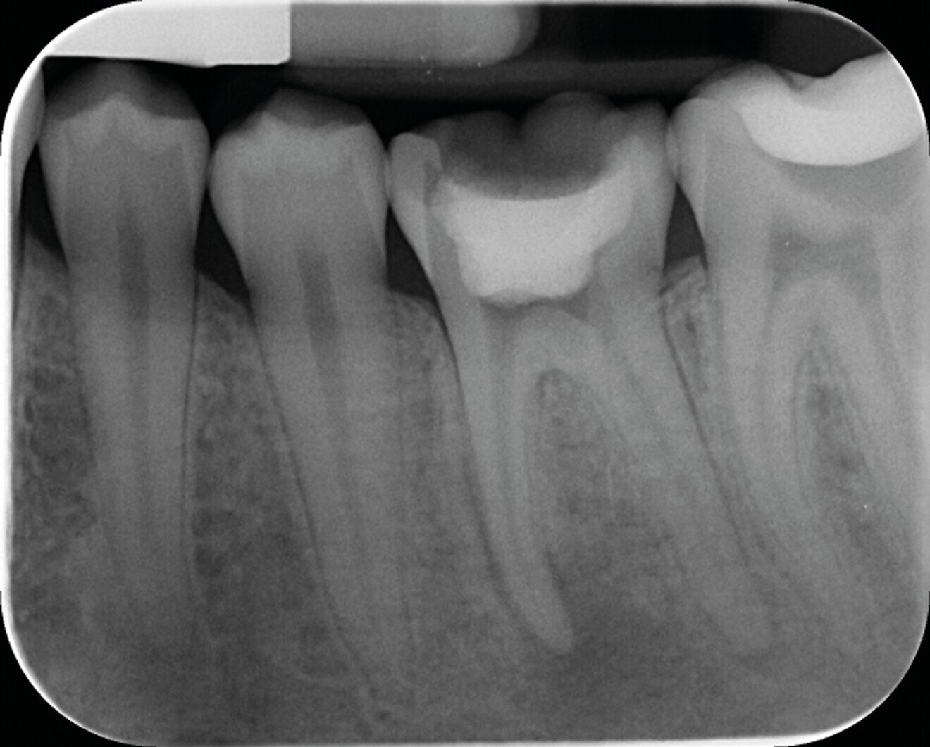 Fig. 7a : Traitement canalaire d’une molaire mandibulaire réalisé avec le système SlimShaper (Zarc – Endoboutik) et obturation avec le CeraSeal (Komet). (a) Radiographie préopératoire.
