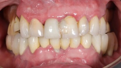 Нов дигитален протокол за възстановяване на цяла зъбна дъга