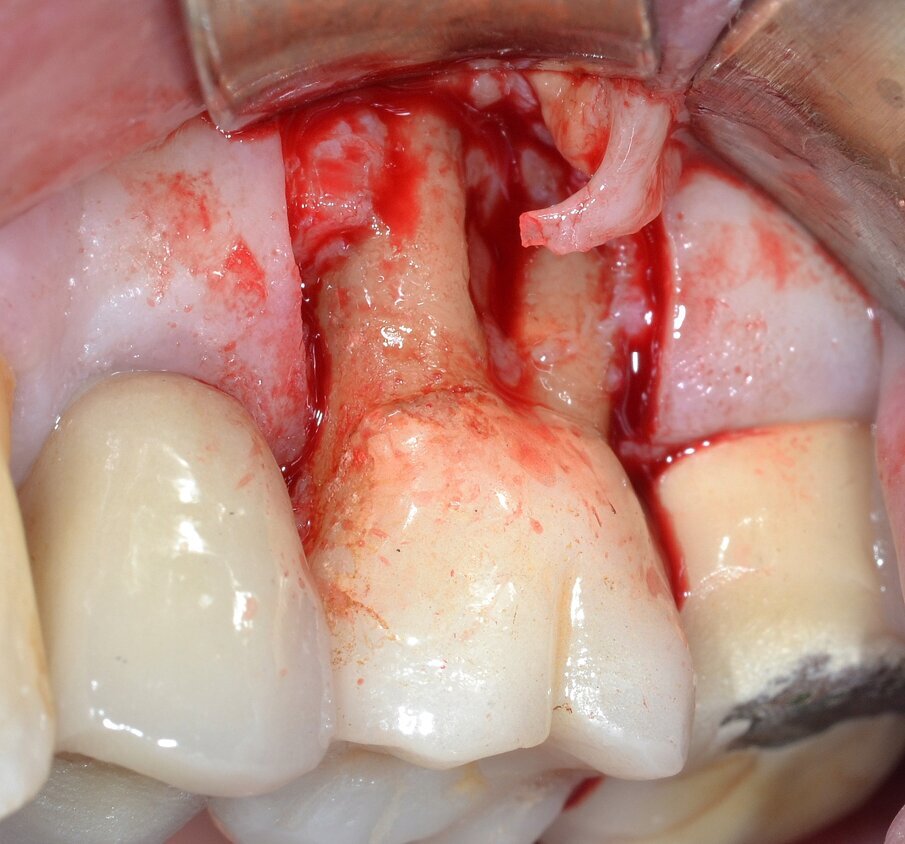 Fig. 4 - Lembo di accesso a spessore totale: coinvolgimento della forcazione radicolare buccale di Classe 3 secondo Hamp & Nyman.