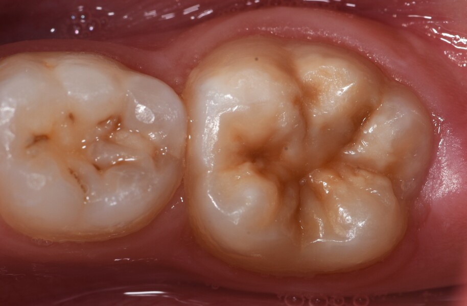 Fig. 1: La MIH afecta a un primer molar permanente y presenta opacidades del esmalte bien delimitadas.