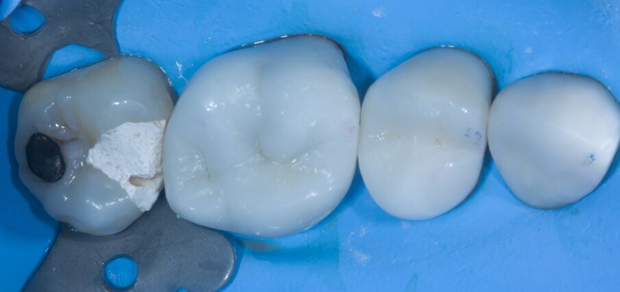 Fig. 1: Situation before treatment. There was a provisional restoration on tooth #27.