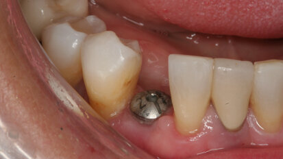 Ημερίδα του ΟΣΑ για τα εμφυτεύματα