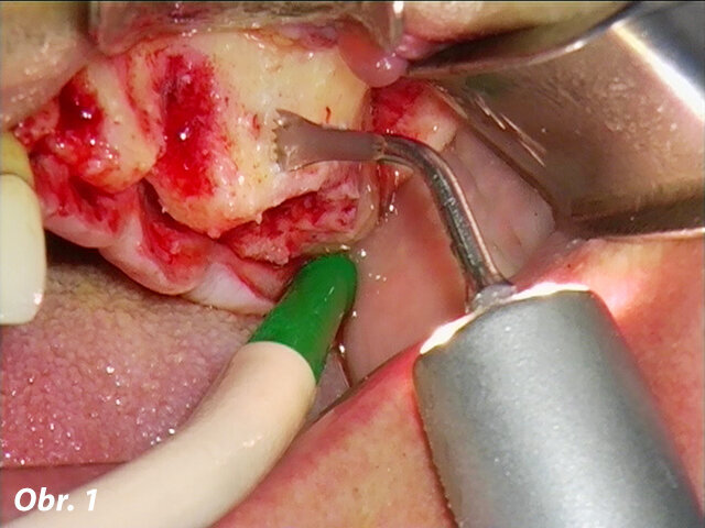 Použití pilky piezo (B1) umožňuje obzvláště přesně definovat okénko v kosti při externím sinus liftu. Díky jemným zubům je ztráta kosti minimální.