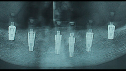 Grave atrofia mandibolare riabilitata con impianti corti a carico immediato