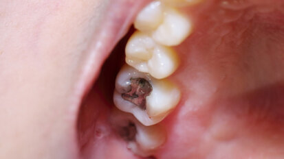 Dentalamalgam: Alternativen für Kinder und Schwangere Dentalamalgam: Alternativen für Kinder und Schwangere