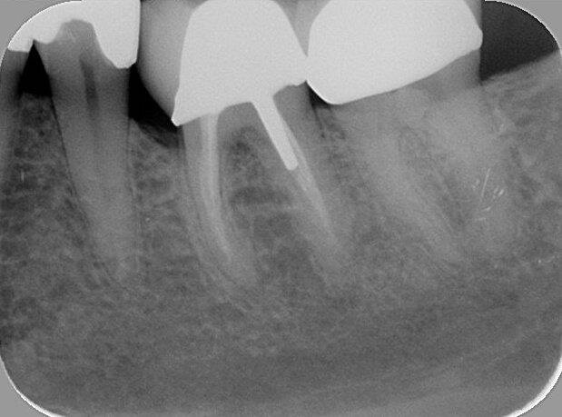 Afb. 7: Gouden kroon vervangen door goud-porseleinkroon, 20-jarige follow-up van de wortelkanaalbehandeling