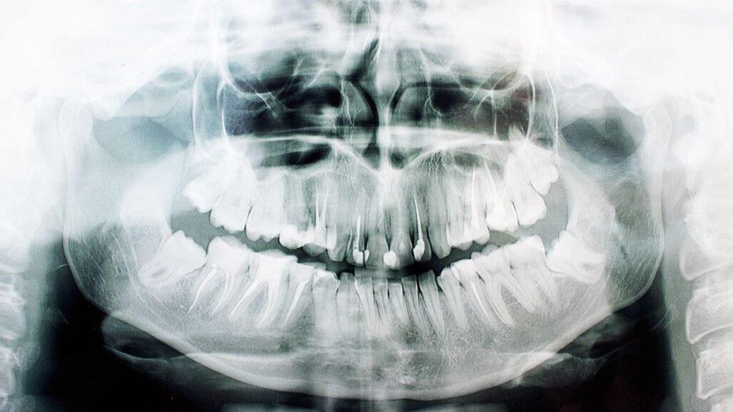 Leeftijd schatten op basis van verstandskiezen niet wetenschappelijk onderbouwd