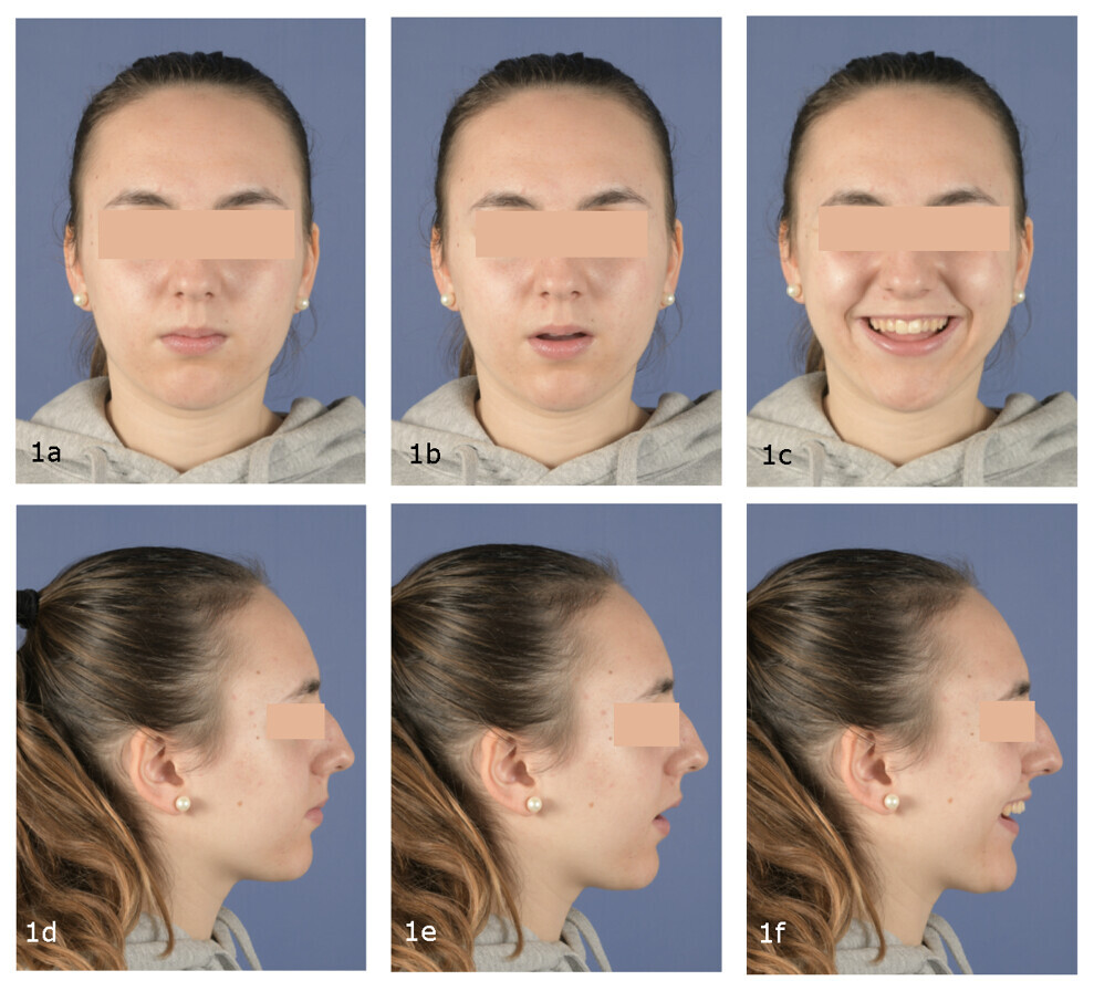 Figs. 1a–f: Pretreatment extra-oral photographs.