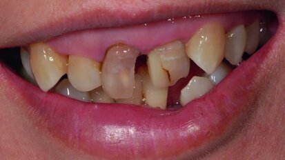 Between BOPT and BTA: A case report on shaping the gingival contour around tooth-supported restorations by means of provisional resin crowns