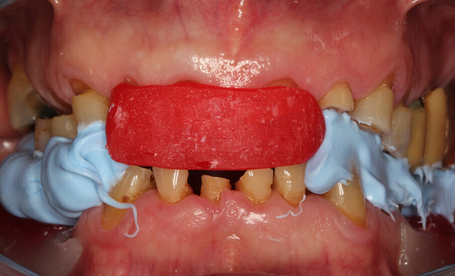 Fig. 2: Bite registration at rest and assessment of the loss of height in vertical dimension 