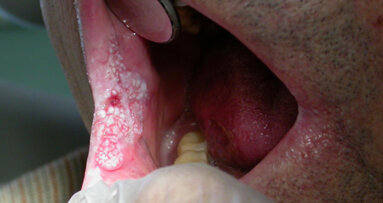 Le correlazioni tra Hpv e carcinoma orofaringeo