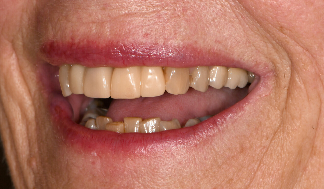 Fig. 10: Long-term temporary restorations in place, lateral view from the left.