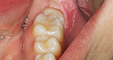 Tratamiento de segundo y tercer molar inferior “enclavados”