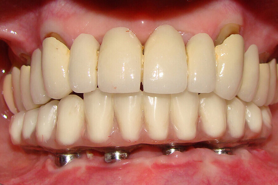 Fig. 25. Rx Pre-operatoria, Prótesis híbrida inmediata con 8 años de evolución y Rx Control a los 8 años.