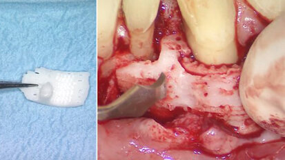 Tessuto dentale stampato in 3D: primo caso di fallimento a lungo termine