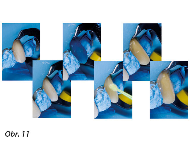 Obr. 11: Fixace finální náhrady v izolaci kofferdamem.
