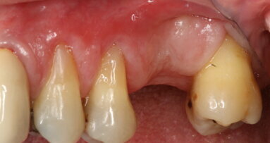 Biomateriali innovativi in implantologia: l’utilizzo di OsteoBiol Putty nel rialzo di seno transcrestale