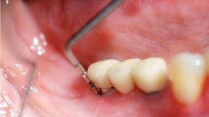 Zastosowanie laserów w leczeniu periimplantitis – przegląd piśmiennictwa