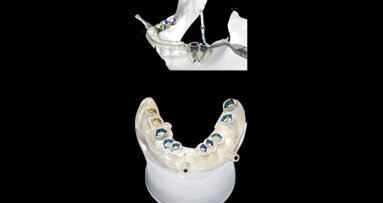 Webinar addresses digital workflow in implantology