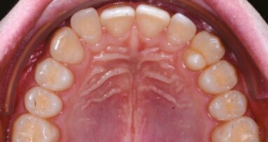 Risoluzione dell’affollamento mediante F22 Aligner