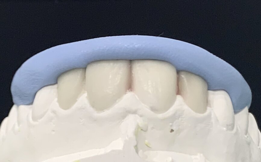 Fig 8 : Silicone Index fabricated with putty impression material 