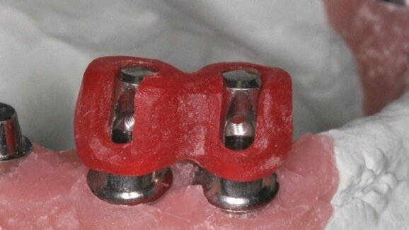 Tomografia komputerowa i możliwości CAD/CAM w planowaniu i leczeniu trudnych przypadków klinicznych