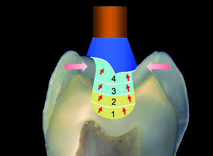 Figs. 8 et 9 : La stratification horizontale n’est pas idéale car les tensions liées a la contraction de polymérisation de la résine composite vont s’exercer sur les parois opposées. La qualité du joint dent/restauration
est meilleure en utilisant une technique de remplissage oblique. 