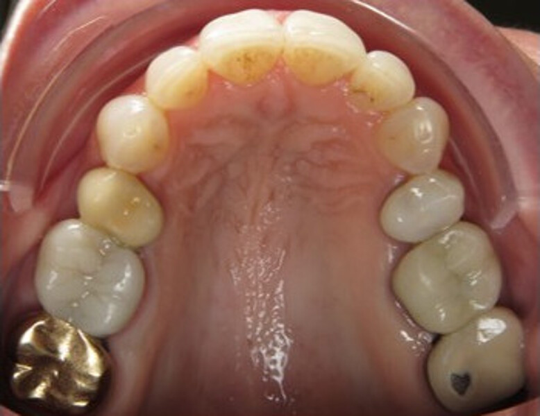 Figs. 8a–e: Final results after 15 steps of aligner treatment.