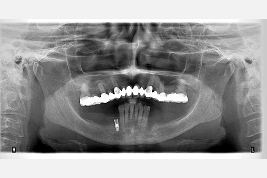 Fig. 24. Rx Pre-operatoria, Prótesis híbrida inmediata con 8 años de evolución y Rx Control a los 8 años.
