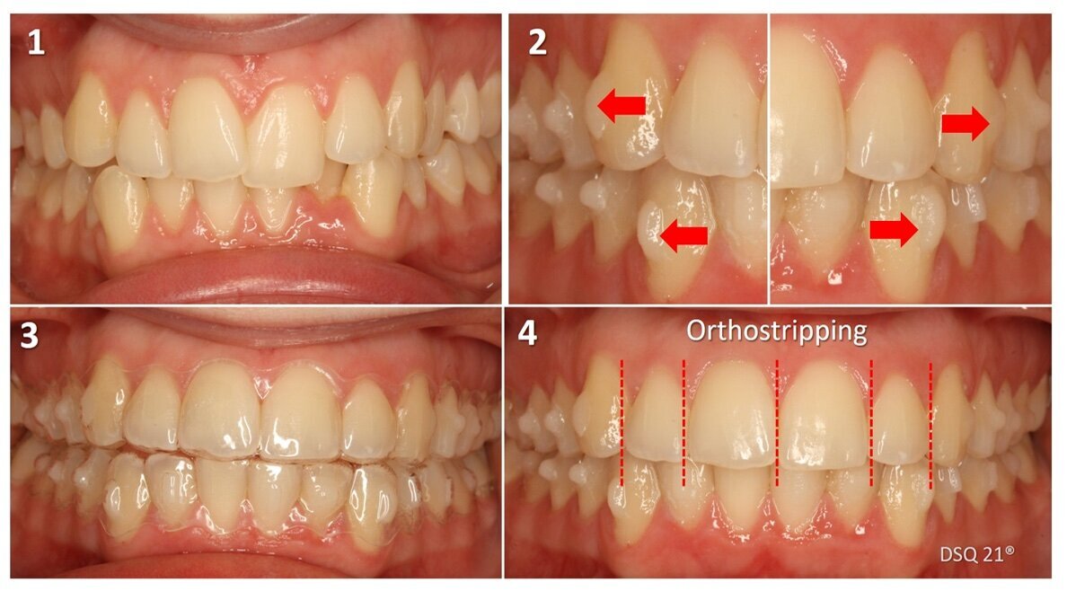 Alineadores: Biomecánica básica de los Ataches (1ª Parte)