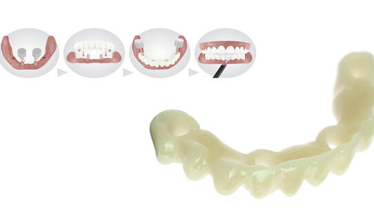 Il ponte Immediate Smile® offre a pazienti e dentisti qualcosa per cui sorridere