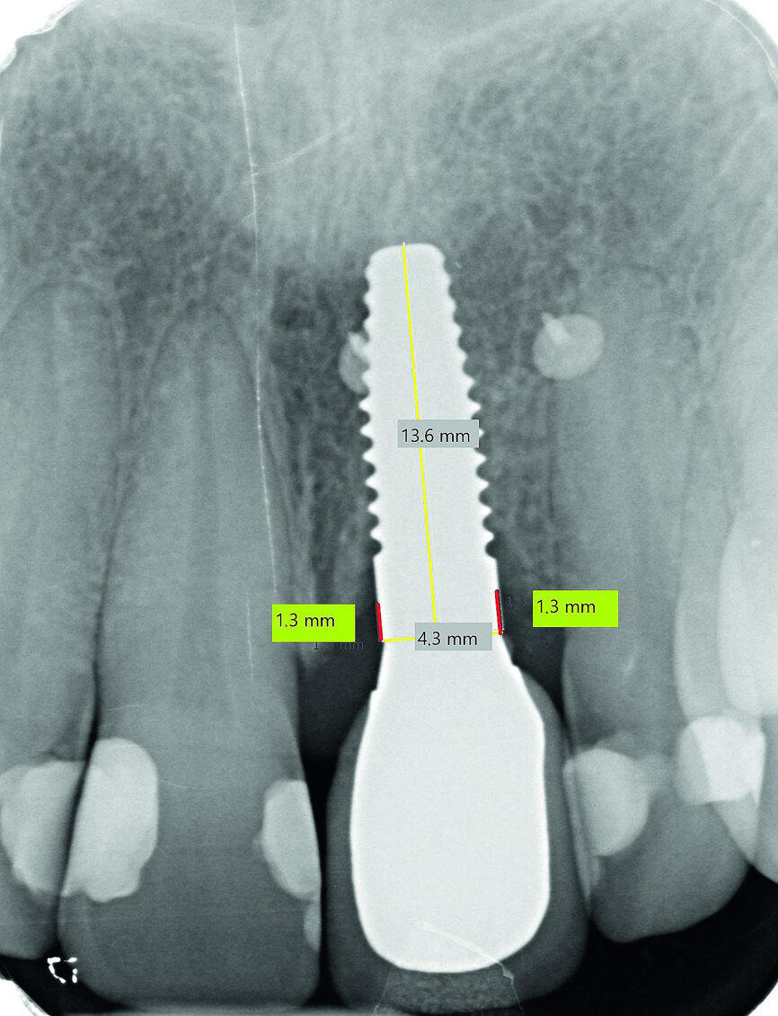 Fig. 13b: Bone resorption was detected after six months and bone gain after 12 months. The yellow line represents the actual implant length (13.6mm). The red lines indicate the mesial and distal distances from the top of the implant to the first bone contact.