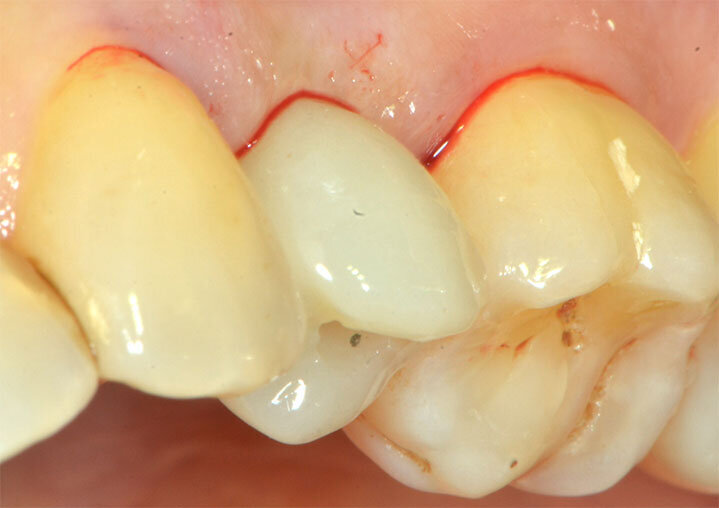 Fig. 19_Dettaglio del progetto protesico in DWS Irix Plus.